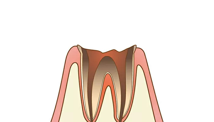 重度の虫歯:被せ物で治療（C4:残根状態）
